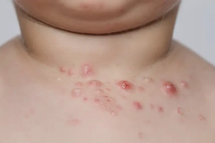 小儿脖子长湿疹能靠自己自愈吗(图3)