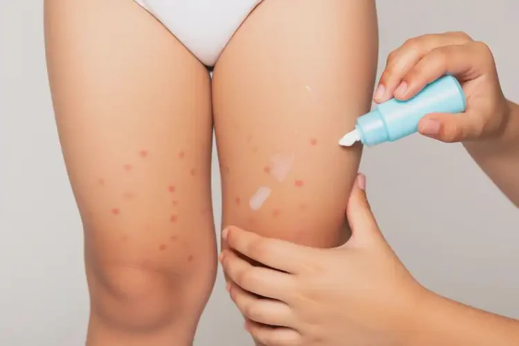 少兒大腿上偶爾長濕疹可不可以根治(圖4)