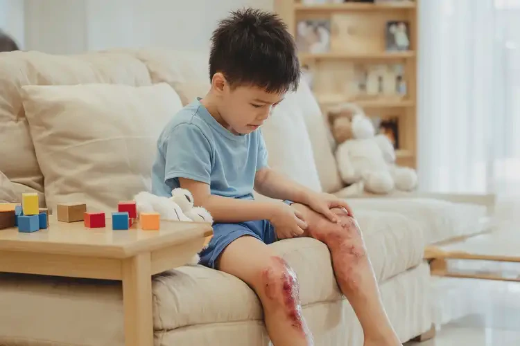 小孩大腿出濕疹不管它會自己痊愈嗎(圖2)