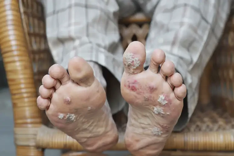 高齡老人腳上起濕疹能不能根治(圖4)