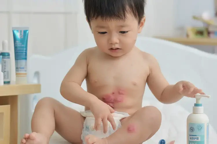 幼兒屁股經(jīng)常長濕疹不管它會自己痊愈嗎(圖4)
