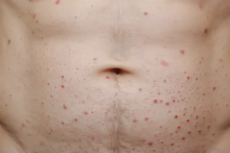 男性肚子偶爾起濕疹可以徹底自愈嗎(圖4)