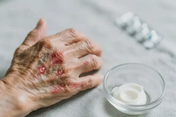 老人手上長濕疹可不可以根治(圖2)