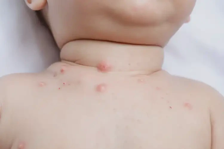 小儿脖子长湿疹能靠自己自愈吗(图4)