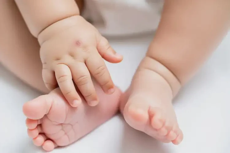 嬰兒四肢經(jīng)常長(zhǎng)濕疹可不可以根治(圖1)