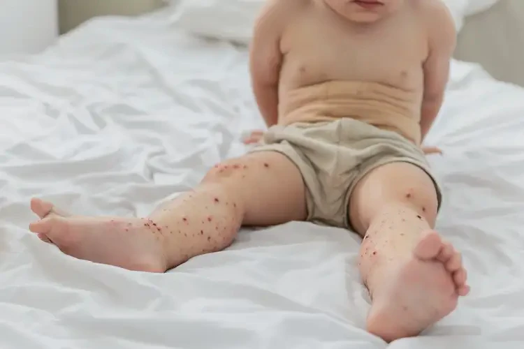 孩子大腿偶爾起濕疹能夠徹底治愈嗎(圖4)