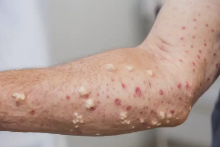 老人全身出濕疹可不可以根治(圖4)