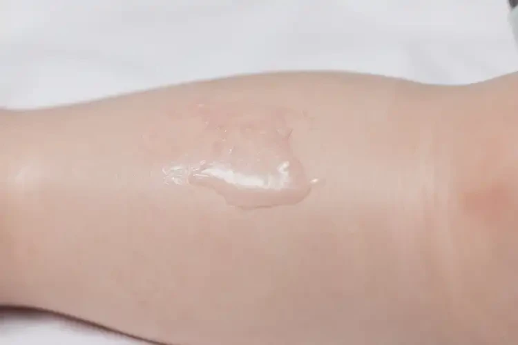 幼兒小腿容易長濕疹能夠徹底治愈嗎(圖2)