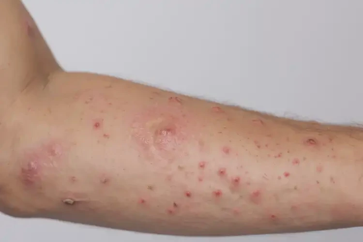 男人手臂偶爾長濕疹不管它會自己自愈嗎(圖4)
