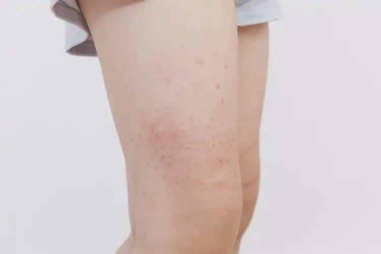 小兒大腿上偶爾長(zhǎng)濕疹可以徹底自愈嗎(圖3)