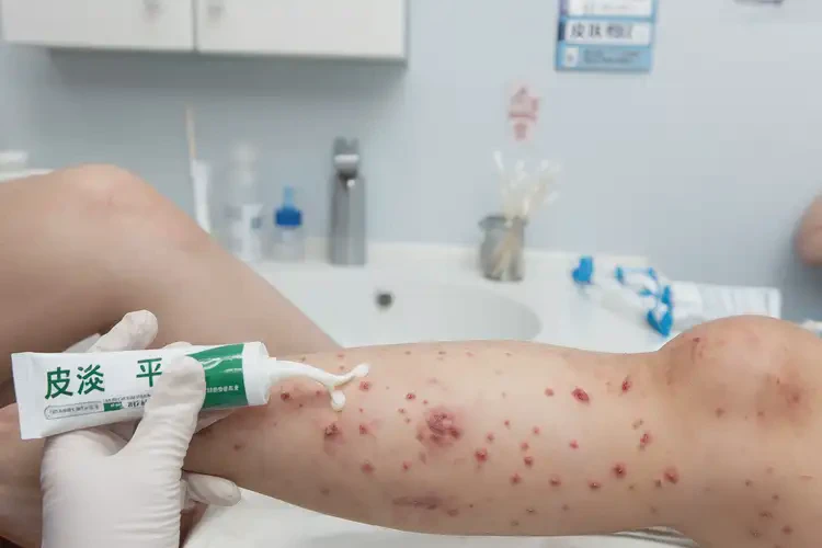 兒童小腿偶爾起濕疹可不可以根治(圖3)