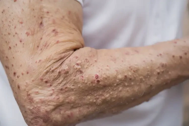 高齡老人手臂上有濕疹能不能根治(圖3)