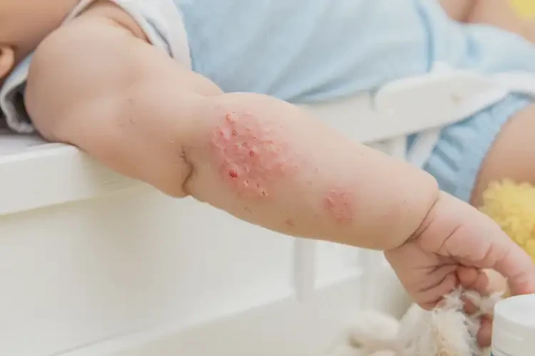 嬰幼兒手臂偶爾長濕疹可不可以根治(圖3)