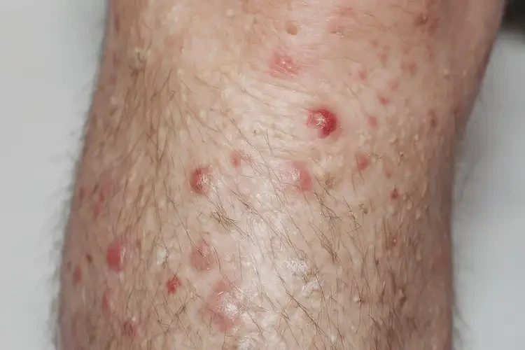 男人小腿出濕疹不管它會自己自愈嗎(圖4)