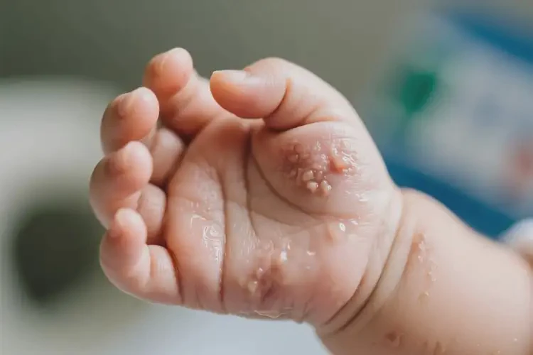 嬰兒手上長(zhǎng)濕疹可不可以根治(圖1)