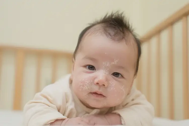 小孩臉上經(jīng)常長濕疹可不可以徹底自愈(圖1)