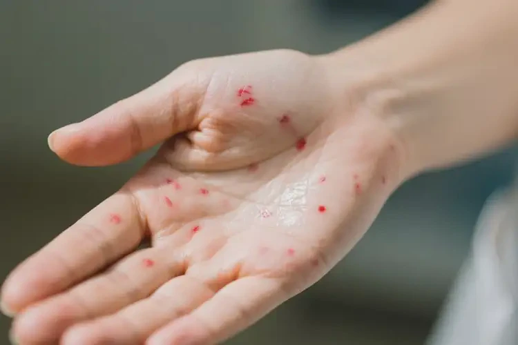 女生手上起濕疹可以徹底自愈嗎(圖2)