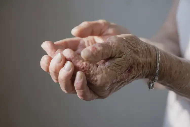 老年人手上有湿疹可不可以彻底自愈(图4)