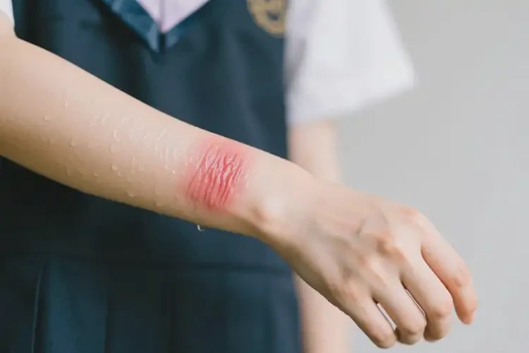 大学生手臂上容易长湿疹可以彻底自愈吗(图3)