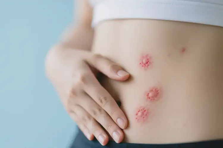 大學(xué)生肚子上有濕疹能徹底自愈嗎(圖1)