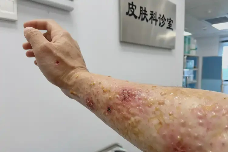 中學(xué)生屁股偶爾起濕疹不管它會自己好嗎(圖3)