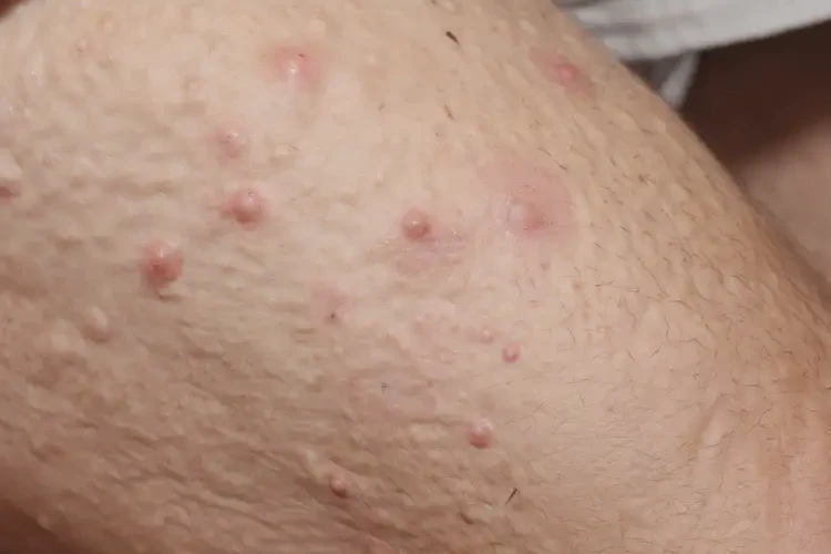 老人大腿上容易長濕疹可不可以根治(圖4)