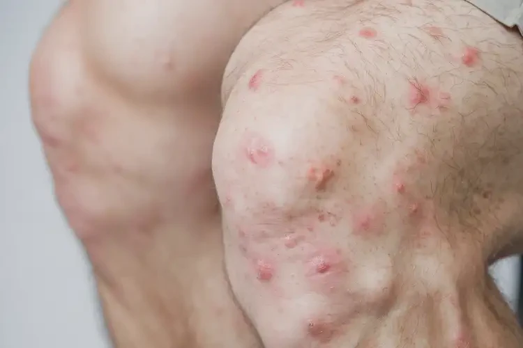 男人四肢經(jīng)常長濕疹能夠徹底治愈嗎(圖3)