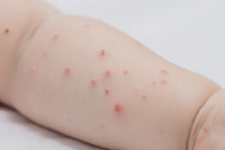 幼儿手臂上容易长湿疹能靠自己自愈吗(图4)