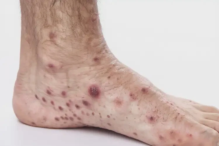 男人小腿上偶尔长湿疹能不能根治(图3)