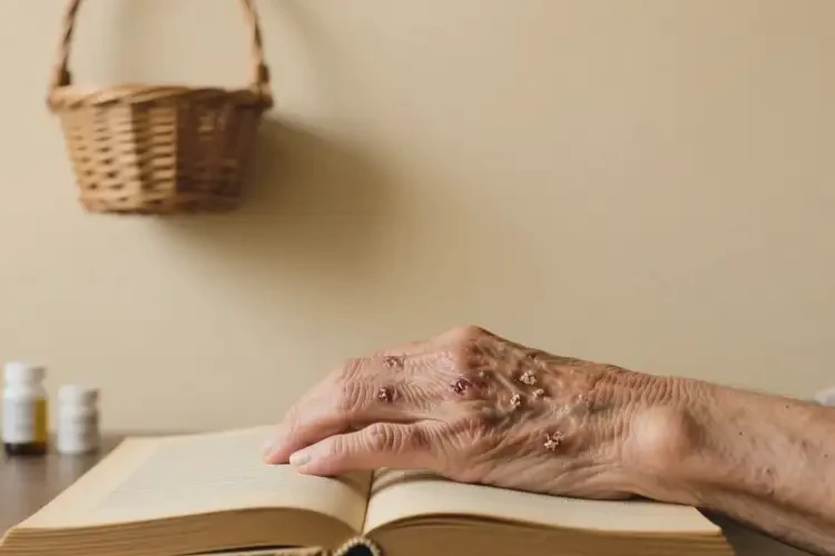 老人手上長濕疹可不可以根治(圖3)
