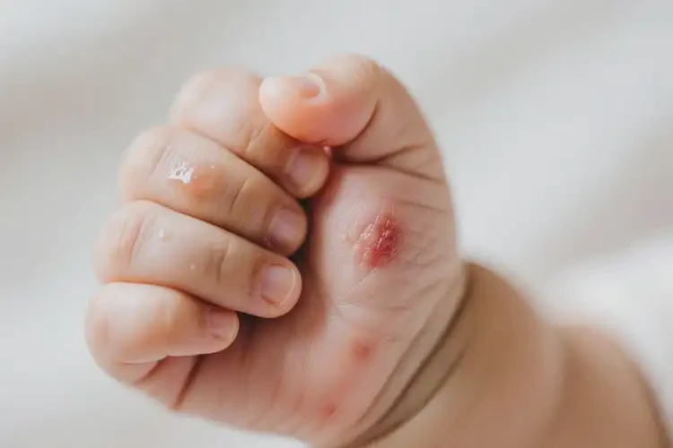 嬰兒手上長(zhǎng)濕疹可不可以根治(圖3)
