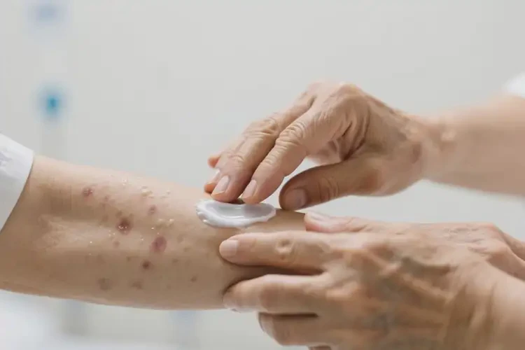 老人手臂偶尔起湿疹可不可以根治(图4)