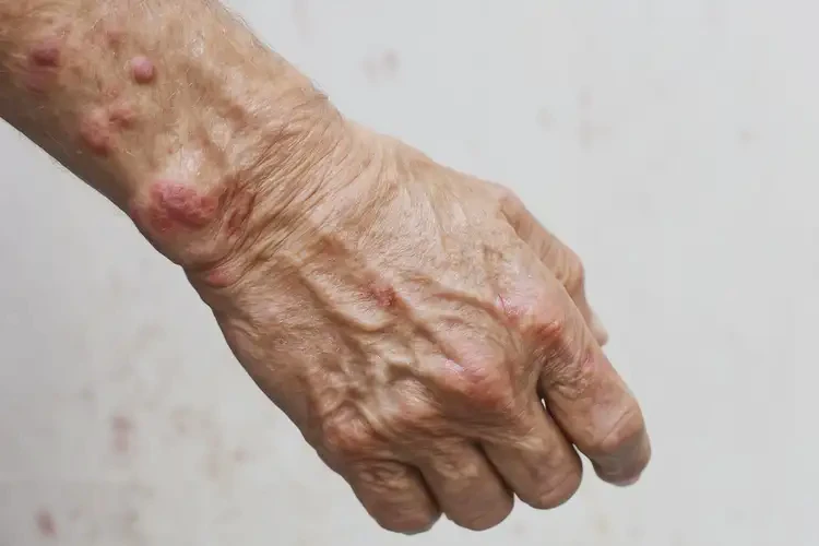 高齡老人手臂上經(jīng)常長濕疹不管它會自己自愈嗎(圖4)