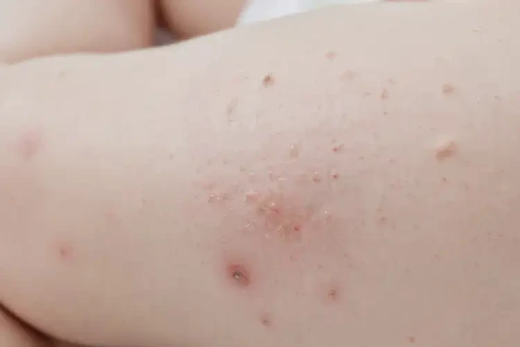 寶寶大腿上出現(xiàn)濕疹可以徹底自愈嗎(圖4)