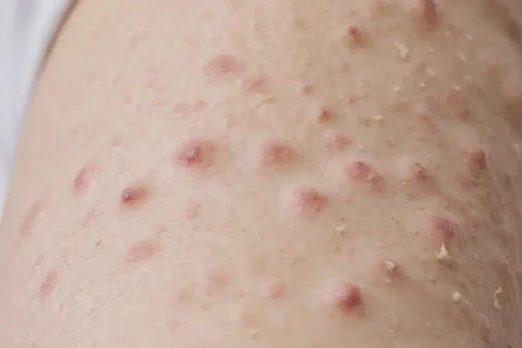 女生手臂上容易長(zhǎng)濕疹能徹底自愈嗎(圖4)