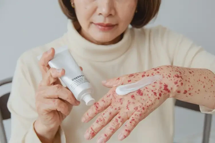 女生手上經常起濕疹不管它會自己痊愈嗎(圖3)