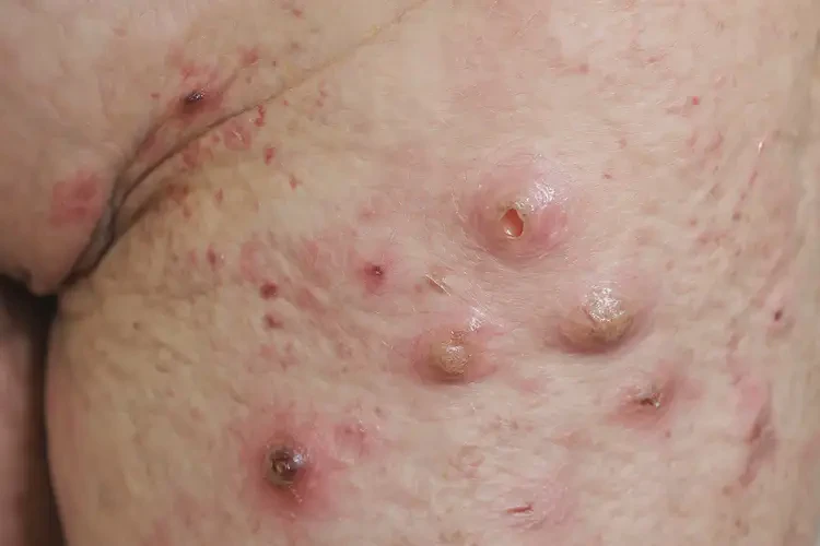 男性肛周偶爾起濕疹不管它會(huì)自己好嗎(圖3)