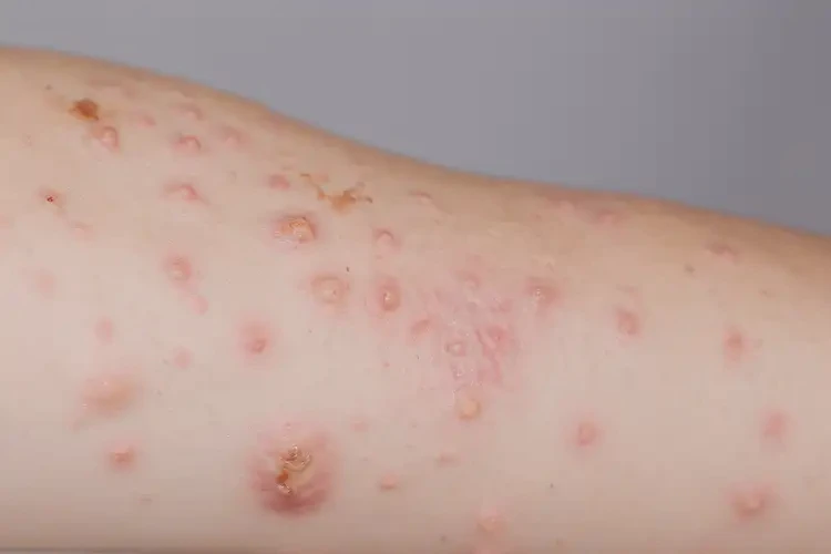 小孩手臂上長濕疹可不可以根治(圖4)