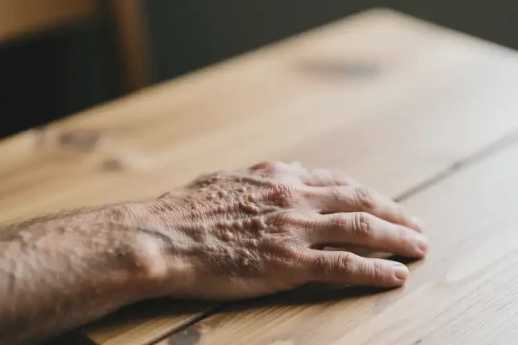 男人手上容易長濕疹可以徹底自愈嗎(圖3)