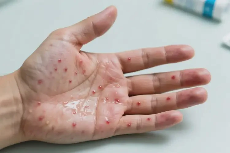 男性手上起濕疹能靠自己自愈嗎(圖4)