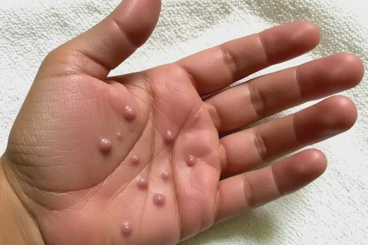 男生身上偶爾長濕疹可以徹底自愈嗎(圖3)