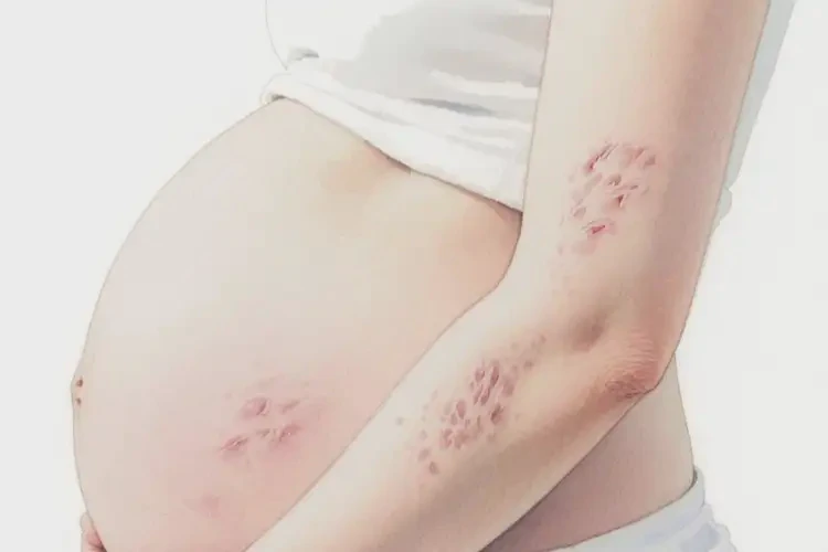 孕婦手臂容易起濕疹能靠自己自愈嗎(圖4)