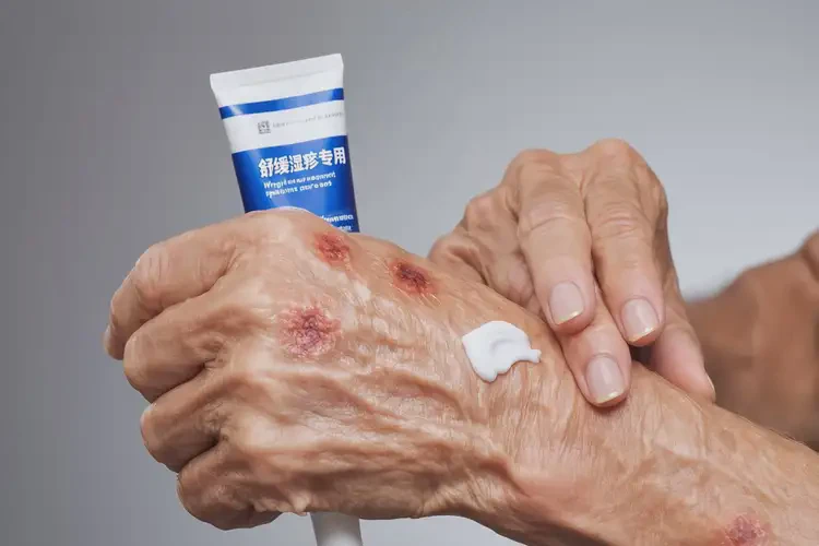 老年人手上有湿疹可不可以彻底自愈(图3)