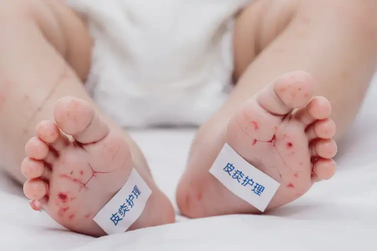嬰兒腳上容易長(zhǎng)濕疹可不可以徹底自愈(圖4)