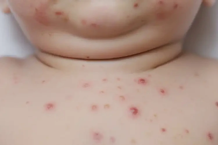 嬰幼兒脖子上容易起濕疹不管它會(huì)自己自愈嗎(圖4)