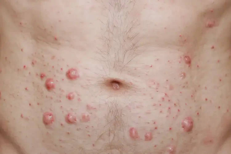 男人肚子上偶爾長濕疹可以徹底自愈嗎(圖4)