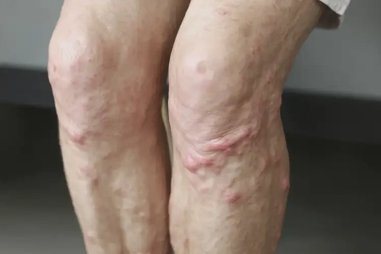 老年人大腿上有濕疹不管它會自己痊愈嗎(圖4)