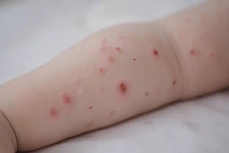 寶寶手臂容易長濕疹可不可以根治(圖4)