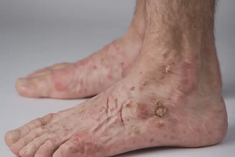 男人腳上容易起濕疹能不能徹底自愈(圖4)