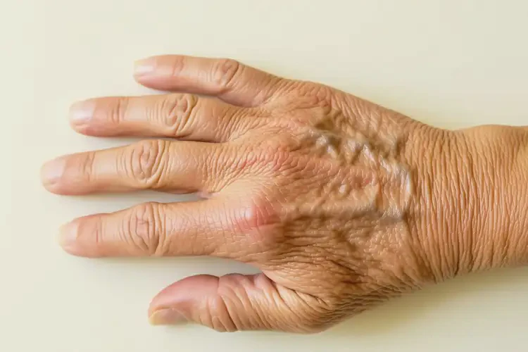 老人手上出濕疹能夠徹底治愈嗎(圖4)